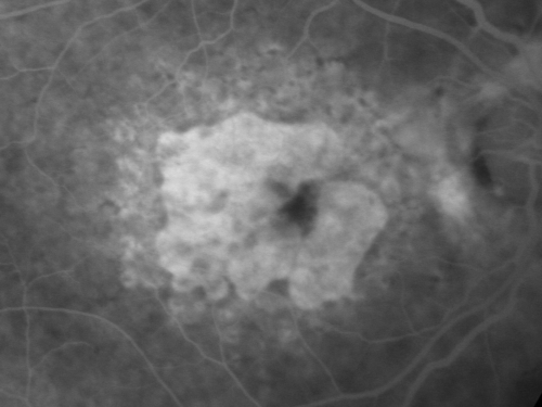 Concentric Geograophic Atrophy - Age-related Macular Degeneration - Charles Bonnet Syndrome - Bulls Eye
88-year-old woman has age-related with vision gradually declining over the last year.  She sees spots in her vision, like red spots and dark spots and she even notices during the daytime, for example when she was looking at her minister, it looked like there were little flowering pots coming out of his head.  

VISUAL ACUITY:  OD 20/200,  OS 20/400.
