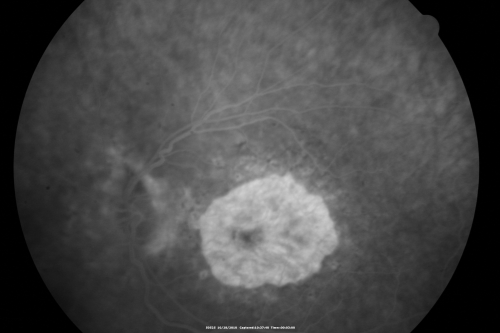 Concentric Geograophic Atrophy - Age-related Macular Degeneration - Charles Bonnet Syndrome - Bulls Eye
88-year-old woman has age-related with vision gradually declining over the last year.  She sees spots in her vision, like red spots and dark spots and she even notices during the daytime, for example when she was looking at her minister, it looked like there were little flowering pots coming out of his head.  

VISUAL ACUITY:  OD 20/200,  OS 20/400.

