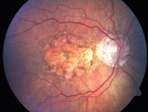 Geographic Atrophy 20/160 Vision
84-year-old woman has age-related macular degeneration in both eyes with foveal atrophy.  She also has a central retinal vein occlusion 
in the left eye for which she had intravitreal Kenalog and finally chorioretinal anastomosis laser a year 
ago.  VISUAL ACUITY:  Vision OD is 20/160, OS is 7/200.
