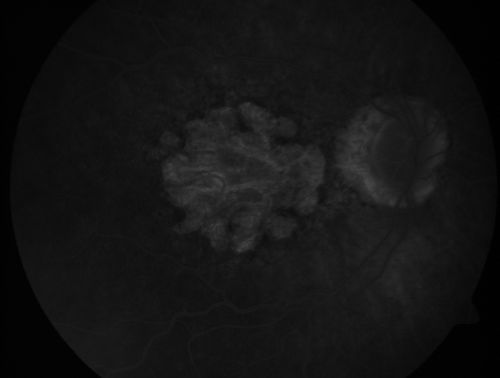 Geographic Atrophy 20/160 Vision
84-year-old woman has age-related macular degeneration in both eyes with foveal atrophy.  She also has a central retinal vein occlusion 
in the left eye for which she had intravitreal Kenalog and finally chorioretinal anastomosis laser a year 
ago.  VISUAL ACUITY:  Vision OD is 20/160, OS is 7/200.
