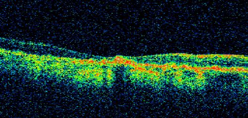 Geographic Atrophy 20/160 Vision
84-year-old woman has age-related macular degeneration in both eyes with foveal atrophy.  She also has a central retinal vein occlusion 
in the left eye for which she had intravitreal Kenalog and finally chorioretinal anastomosis laser a year 
ago.  VISUAL ACUITY:  Vision OD is 20/160, OS is 7/200.
