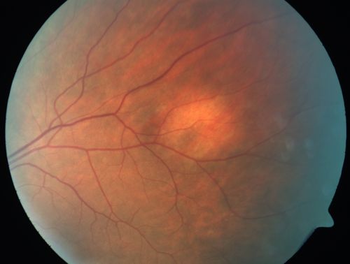 Amelanotic Nevus - 1 year Follow-up Visit - No Change
