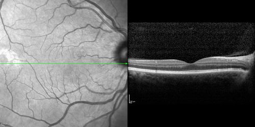 Acute Macular Neuroretinopathy - (AMN) - Spot in Vision OS - 40 Year old Female
