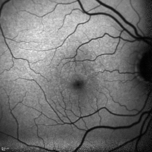 Acute Macular Neuroretinopathy - (AMN) - Spot in Vision OS - 40 Year old Female
FAF is normal
