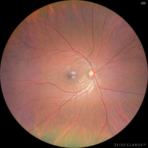 Pigmented Cystic Retinal Tuft
Asymptomatic 20 year old male

