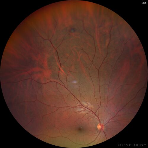 Pigmented Cystic Retinal Tuft
Asymptomatic 20 year old male
