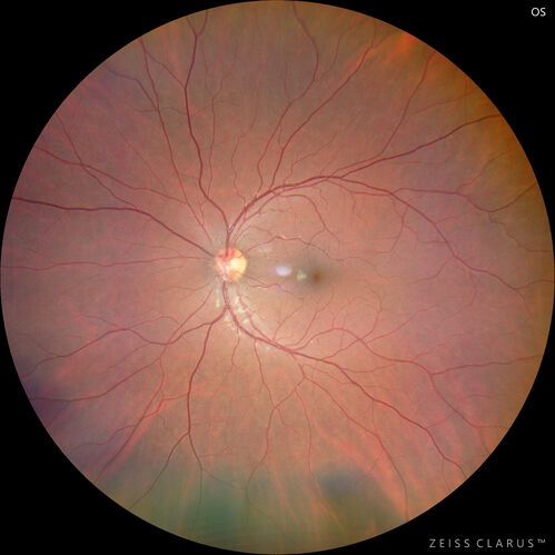 Pigmented Cystic Retinal Tuft
Asymptomatic 20 year old male
