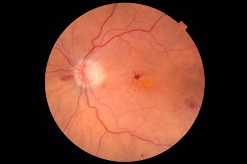 Anemic Retinopathy
Myelodysplasia - HgB 8 and very low platelet count
