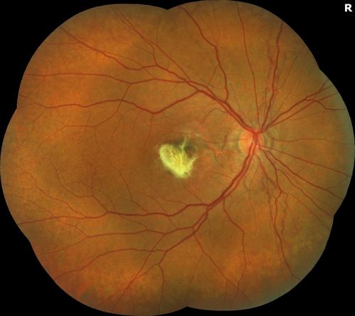 Angioid Streaks Scar and new CNVM
49 y/o WF with decreased vision x 1 month.  Her OD is 20/400 and her OS is seeing 20/70.  No cutaneous lesions or Ehlers-Danlos. The FP and FA  show a predominant classic CNV (with fibrosis) OD and an Occult CNV OS with what appears to be a RAP lesion.
