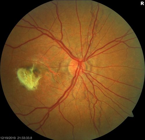 Angioid Streaks Scar and new CNVM
49 y/o WF with decreased vision x 1 month.  Her OD is 20/400 and her OS is seeing 20/70.  No cutaneous lesions or Ehlers-Danlos. The FP and FA  show a predominant classic CNV (with fibrosis) OD and an Occult CNV OS with what appears to be a RAP lesion.
