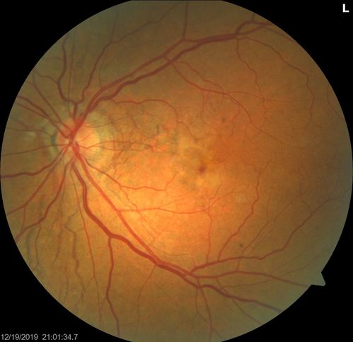 Angioid Streaks Scar and new CNVM
49 y/o WF with decreased vision x 1 month.  Her OD is 20/400 and her OS is seeing 20/70.  No cutaneous lesions or Ehlers-Danlos. The FP and FA  show a predominant classic CNV (with fibrosis) OD and an Occult CNV OS with what appears to be a RAP lesion.
