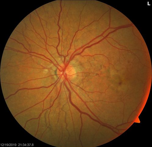 Angioid Streaks Scar and new CNVM
49 y/o WF with decreased vision x 1 month.  Her OD is 20/400 and her OS is seeing 20/70.  No cutaneous lesions or Ehlers-Danlos. The FP and FA  show a predominant classic CNV (with fibrosis) OD and an Occult CNV OS with what appears to be a RAP lesion.
