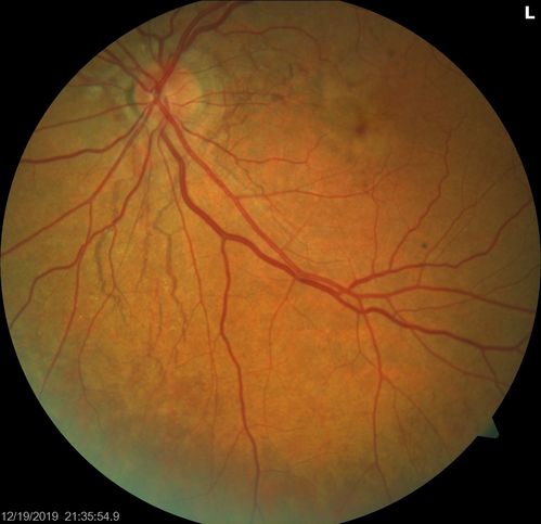 Angioid Streaks Scar and new CNVM
49 y/o WF with decreased vision x 1 month.  Her OD is 20/400 and her OS is seeing 20/70.  No cutaneous lesions or Ehlers-Danlos. The FP and FA  show a predominant classic CNV (with fibrosis) OD and an Occult CNV OS with what appears to be a RAP lesion.
