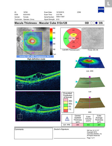 Angioid Streaks Scar and new CNVM
49 y/o WF with decreased vision x 1 month.  Her OD is 20/400 and her OS is seeing 20/70.  No cutaneous lesions or Ehlers-Danlos. The FP and FA  show a predominant classic CNV (with fibrosis) OD and an Occult CNV OS with what appears to be a RAP lesion.
