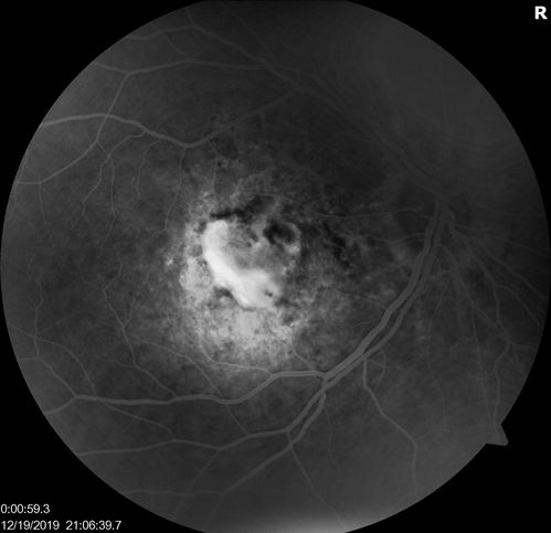 Angioid Streaks Scar and new CNVM
49 y/o WF with decreased vision x 1 month.  Her OD is 20/400 and her OS is seeing 20/70.  No cutaneous lesions or Ehlers-Danlos. The FP and FA  show a predominant classic CNV (with fibrosis) OD and an Occult CNV OS with what appears to be a RAP lesion.
