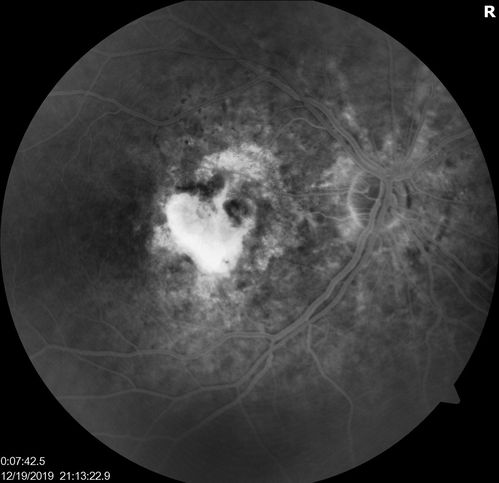 Angioid Streaks Scar and new CNVM
49 y/o WF with decreased vision x 1 month.  Her OD is 20/400 and her OS is seeing 20/70.  No cutaneous lesions or Ehlers-Danlos. The FP and FA  show a predominant classic CNV (with fibrosis) OD and an Occult CNV OS with what appears to be a RAP lesion.
