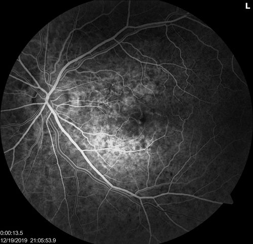 Angioid Streaks Scar and new CNVM
49 y/o WF with decreased vision x 1 month.  Her OD is 20/400 and her OS is seeing 20/70.  No cutaneous lesions or Ehlers-Danlos. The FP and FA  show a predominant classic CNV (with fibrosis) OD and an Occult CNV OS with what appears to be a RAP lesion.
