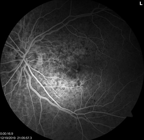Angioid Streaks Scar and new CNVM
49 y/o WF with decreased vision x 1 month.  Her OD is 20/400 and her OS is seeing 20/70.  No cutaneous lesions or Ehlers-Danlos. The FP and FA  show a predominant classic CNV (with fibrosis) OD and an Occult CNV OS with what appears to be a RAP lesion.
