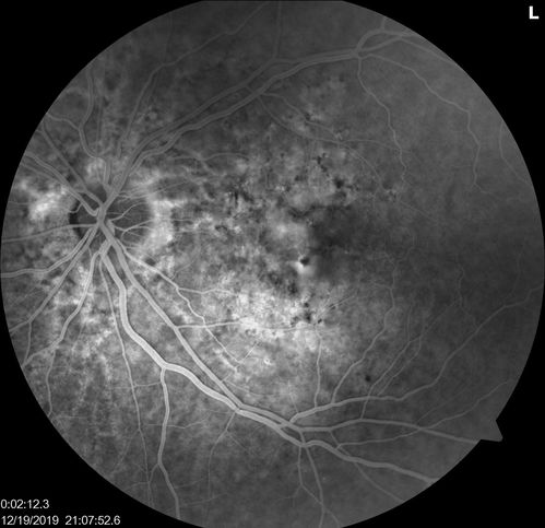 Angioid Streaks Scar and new CNVM
49 y/o WF with decreased vision x 1 month.  Her OD is 20/400 and her OS is seeing 20/70.  No cutaneous lesions or Ehlers-Danlos. The FP and FA  show a predominant classic CNV (with fibrosis) OD and an Occult CNV OS with what appears to be a RAP lesion.
