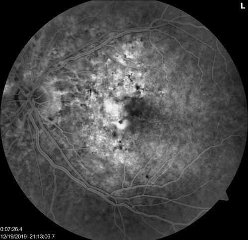Angioid Streaks Scar and new CNVM
49 y/o WF with decreased vision x 1 month.  Her OD is 20/400 and her OS is seeing 20/70.  No cutaneous lesions or Ehlers-Danlos. The FP and FA  show a predominant classic CNV (with fibrosis) OD and an Occult CNV OS with what appears to be a RAP lesion.

