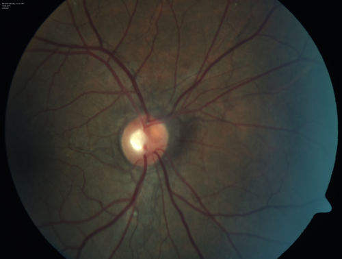 Angioid Streaks - CNVM OS with vision loss
48 year old soccer player.  Prior trauma OS (with soccer ball).  Vision loss for 3 weeks to 20/60 - with Lucentis vision improved to 20/30
