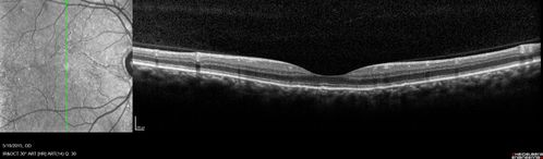 Angioid Streaks - CNVM OS with vision loss
48 year old soccer player.  Prior trauma OS (with soccer ball).  Vision loss for 3 weeks to 20/60 - with Lucentis vision improved to 20/30
