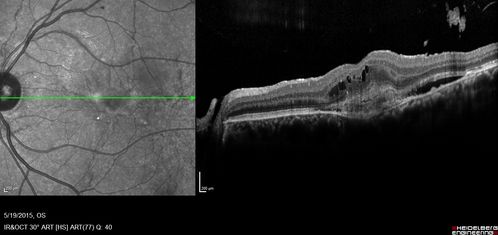 Angioid Streaks - CNVM OS with vision loss
48 year old soccer player.  Prior trauma OS (with soccer ball).  Vision loss for 3 weeks to 20/60 - with Lucentis vision improved to 20/30

