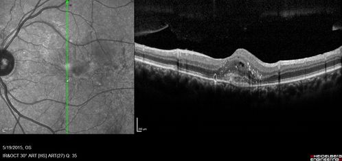 Angioid Streaks - CNVM OS with vision loss
48 year old soccer player.  Prior trauma OS (with soccer ball).  Vision loss for 3 weeks to 20/60 - with Lucentis vision improved to 20/30
