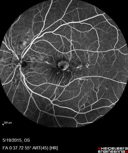 Angioid Streaks - CNVM OS with vision loss
48 year old soccer player.  Prior trauma OS (with soccer ball).  Vision loss for 3 weeks to 20/60 - with Lucentis vision improved to 20/30
