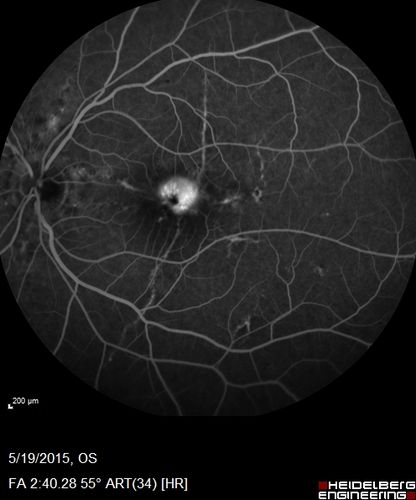 Angioid Streaks - CNVM OS with vision loss
48 year old soccer player.  Prior trauma OS (with soccer ball).  Vision loss for 3 weeks to 20/60 - with Lucentis vision improved to 20/30
