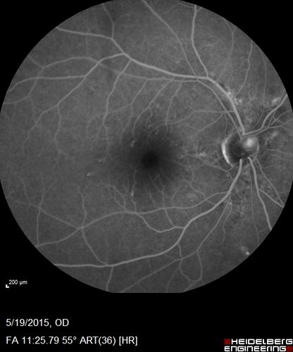 Angioid Streaks - CNVM OS with vision loss
48 year old soccer player.  Prior trauma OS (with soccer ball).  Vision loss for 3 weeks to 20/60 - with Lucentis vision improved to 20/30
