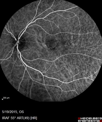 Angioid Streaks - CNVM OS with vision loss
48 year old soccer player.  Prior trauma OS (with soccer ball).  Vision loss for 3 weeks to 20/60 - with Lucentis vision improved to 20/30
