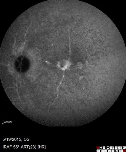Angioid Streaks - CNVM OS with vision loss
48 year old soccer player.  Prior trauma OS (with soccer ball).  Vision loss for 3 weeks to 20/60 - with Lucentis vision improved to 20/30
