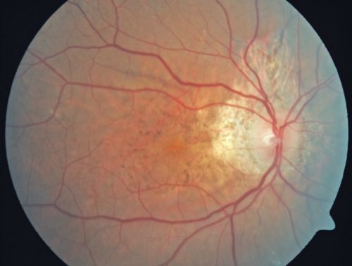 Angioid Streaks - Pseudoxanthoma Elasticum - Supressed CNVM
54-year-old woman had angioid streaks and macular degeneration in both eyes.  She has had intravitreal Avastin in the right eye about every three months and her vision in that eye is good.

VISUAL ACUITY:  Vision OD is 20/30, OS is 2/200
