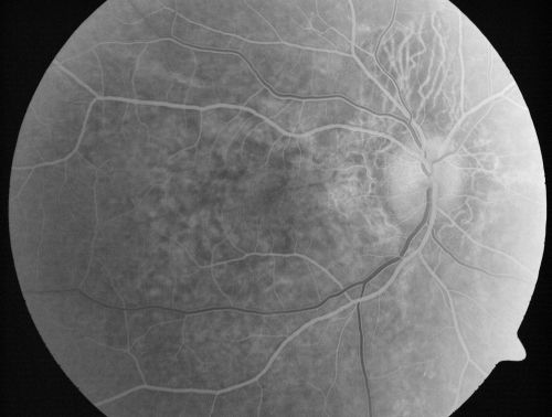 Angioid Streaks - Pseudoxanthoma Elasticum - Supressed CNVM
54-year-old woman had angioid streaks and macular degeneration in both eyes.  She has had intravitreal Avastin in the right eye about every three months and her vision in that eye is good.

VISUAL ACUITY:  Vision OD is 20/30, OS is 2/200
