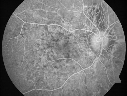 Angioid Streaks - Pseudoxanthoma Elasticum - Supressed CNVM
54-year-old woman had angioid streaks and macular degeneration in both eyes.  She has had intravitreal Avastin in the right eye about every three months and her vision in that eye is good.

VISUAL ACUITY:  Vision OD is 20/30, OS is 2/200
