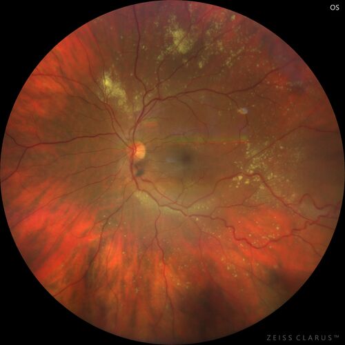 Retinal Angioma
46 year old female - Her original reason for an eye examination was that she had been in a car accident.  Then she saw that the vision was blurry in just the left eye.  Prior to that she had no known vision changes.  Since the accident she notices that her vision is better and her headaches are getting less bothersome.
PMhx benign, Meds: none
VA OD: Dcc20/20
VA OS: Dcc20/25
