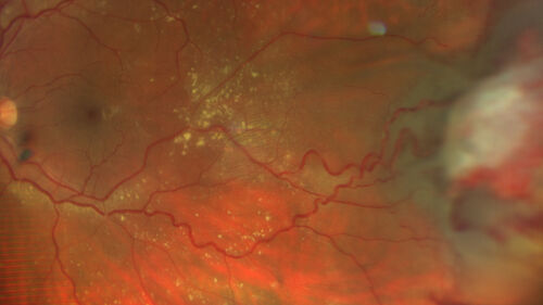 Retinal Angioma
46 year old female - Her original reason for an eye examination was that she had been in a car accident.  Then she saw that the vision was blurry in just the left eye.  Prior to that she had no known vision changes.  Since the accident she notices that her vision is better and her headaches are getting less bothersome.
PMhx benign, Meds: none
VA OD: Dcc20/20
VA OS: Dcc20/25
