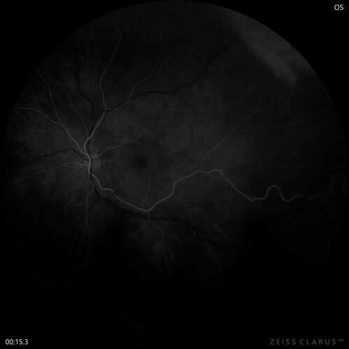 Retinal Angioma
46 year old female - Her original reason for an eye examination was that she had been in a car accident.  Then she saw that the vision was blurry in just the left eye.  Prior to that she had no known vision changes.  Since the accident she notices that her vision is better and her headaches are getting less bothersome.
PMhx benign, Meds: none
VA OD: Dcc20/20
VA OS: Dcc20/25
