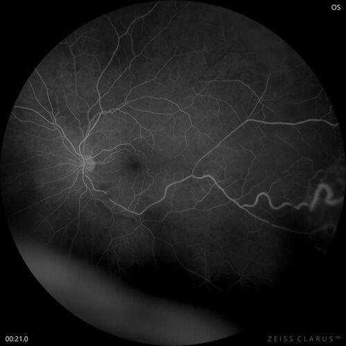 Retinal Angioma
46 year old female - Her original reason for an eye examination was that she had been in a car accident.  Then she saw that the vision was blurry in just the left eye.  Prior to that she had no known vision changes.  Since the accident she notices that her vision is better and her headaches are getting less bothersome.
PMhx benign, Meds: none
VA OD: Dcc20/20
VA OS: Dcc20/25
