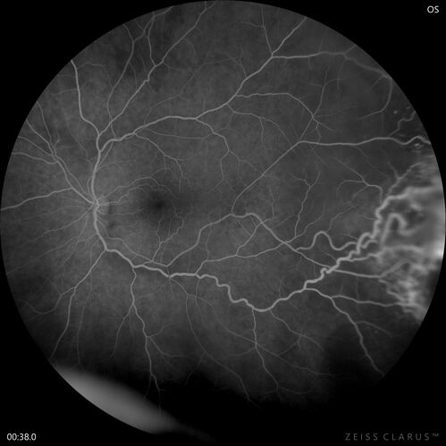 Retinal Angioma
46 year old female - Her original reason for an eye examination was that she had been in a car accident.  Then she saw that the vision was blurry in just the left eye.  Prior to that she had no known vision changes.  Since the accident she notices that her vision is better and her headaches are getting less bothersome.
PMhx benign, Meds: none
VA OD: Dcc20/20
VA OS: Dcc20/25

