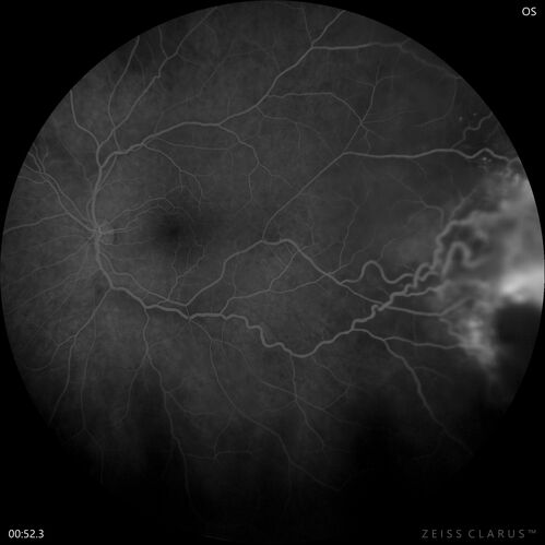 Retinal Angioma
46 year old female - Her original reason for an eye examination was that she had been in a car accident.  Then she saw that the vision was blurry in just the left eye.  Prior to that she had no known vision changes.  Since the accident she notices that her vision is better and her headaches are getting less bothersome.
PMhx benign, Meds: none
VA OD: Dcc20/20
VA OS: Dcc20/25
