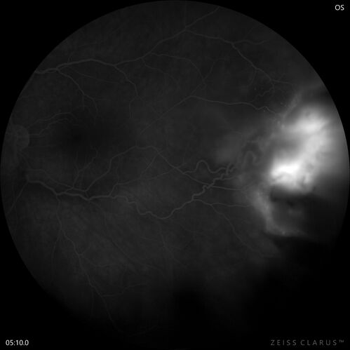 Retinal Angioma
46 year old female - Her original reason for an eye examination was that she had been in a car accident.  Then she saw that the vision was blurry in just the left eye.  Prior to that she had no known vision changes.  Since the accident she notices that her vision is better and her headaches are getting less bothersome.
PMhx benign, Meds: none
VA OD: Dcc20/20
VA OS: Dcc20/25
