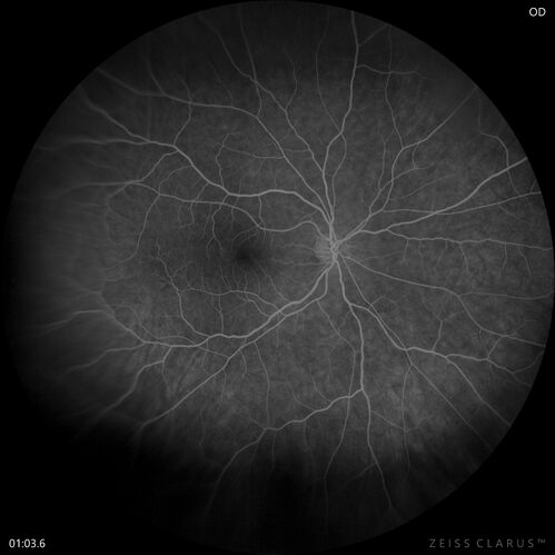 Retinal Angioma
46 year old female - Her original reason for an eye examination was that she had been in a car accident.  Then she saw that the vision was blurry in just the left eye.  Prior to that she had no known vision changes.  Since the accident she notices that her vision is better and her headaches are getting less bothersome.
PMhx benign, Meds: none
VA OD: Dcc20/20
VA OS: Dcc20/25
