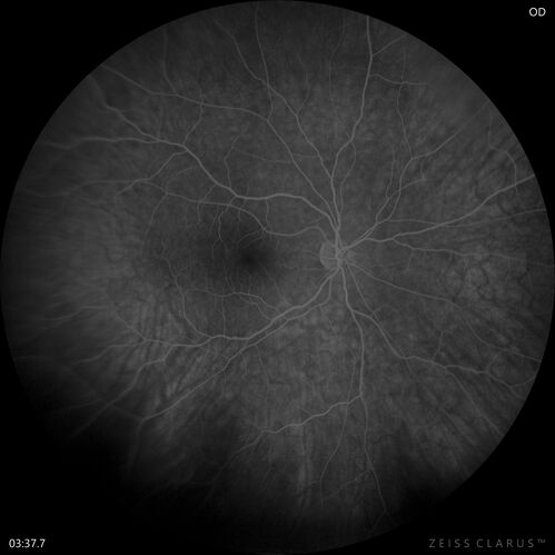 Retinal Angioma
46 year old female - Her original reason for an eye examination was that she had been in a car accident.  Then she saw that the vision was blurry in just the left eye.  Prior to that she had no known vision changes.  Since the accident she notices that her vision is better and her headaches are getting less bothersome.
PMhx benign, Meds: none
VA OD: Dcc20/20
VA OS: Dcc20/25
