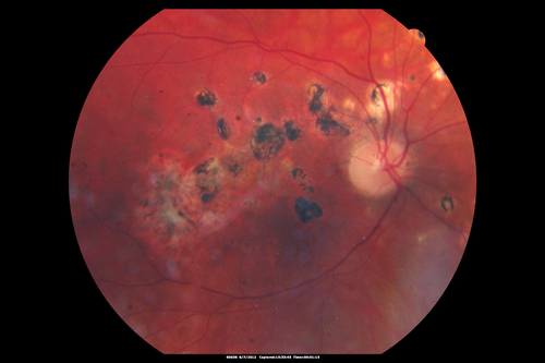Punctate Inner Choroidopathy - Recurrent CNVM 4 years after initial treatment Left Eye 
June 7, 2012.  This pleasant 35-year-old woman noticed decreasing vision in the left eye recently.   She returns now noticing the vision in the left eye is declining.   OD 20/50,  OS 20/80.  OS: Vertical C/D ratio is 0.3.  There is a scar just inferonasal to the fovea, which has grown some towards the fovea with a little blood just under the fovea.  


