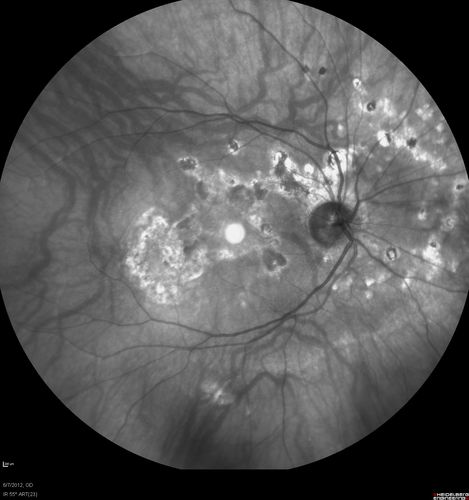 Punctate Inner Choroidopathy - Recurrent CNVM 4 years after initial treatment Left Eye 
June 7, 2012.  This pleasant 35-year-old woman noticed decreasing vision in the left eye recently.   She returns now noticing the vision in the left eye is declining.   OD 20/50,  OS 20/80.  OS: Vertical C/D ratio is 0.3.  There is a scar just inferonasal to the fovea, which has grown some towards the fovea with a little blood just under the fovea.  


