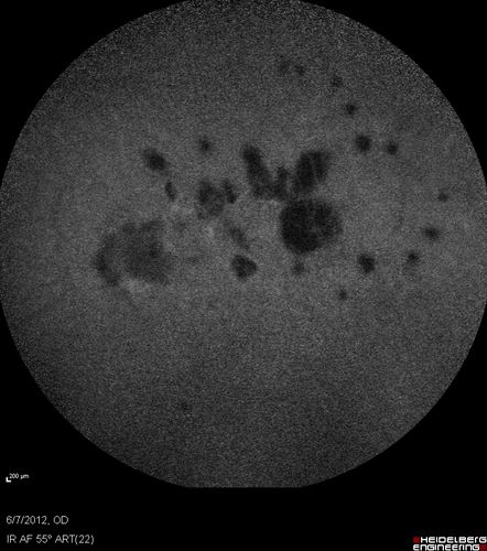 Punctate Inner Choroidopathy - Recurrent CNVM 4 years after initial treatment Left Eye - Indocyanine Green Angiogram
June 7, 2012.  This pleasant 35-year-old woman noticed decreasing vision in the left eye recently.   She returns now noticing the vision in the left eye is declining.   OD 20/50,  OS 20/80.  OS: Vertical C/D ratio is 0.3.  There is a scar just inferonasal to the fovea, which has grown some towards the fovea with a little blood just under the fovea.  


