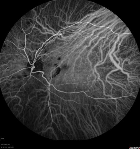 Punctate Inner Choroidopathy - Recurrent CNVM 4 years after initial treatment Left Eye - Indocyanine Green Angiogram
June 7, 2012.  This pleasant 35-year-old woman noticed decreasing vision in the left eye recently.   She returns now noticing the vision in the left eye is declining.   OD 20/50,  OS 20/80.  OS: Vertical C/D ratio is 0.3.  There is a scar just inferonasal to the fovea, which has grown some towards the fovea with a little blood just under the fovea.  


