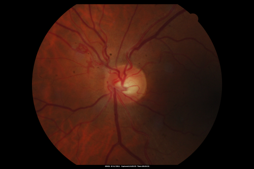 Anomalous Branch Retinal Artery 
59-year-old man  OD 20/25,  OS 20/25.  TORTUOUS RETINAL ARTERY â€“ LEF EYE 
(POSSIBLE GROUP 2 WYBURN-MASON SYNDROME
POSSIBLE ACEPHALIC MIGRAINES )
